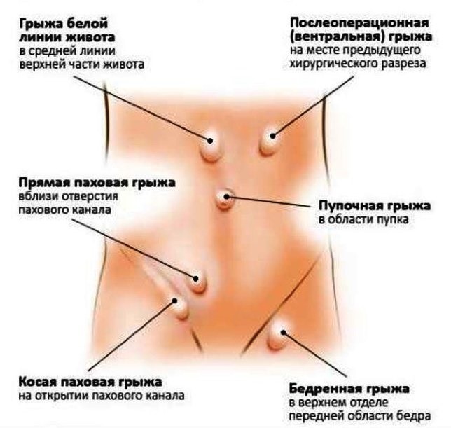 Разновидности грыж
