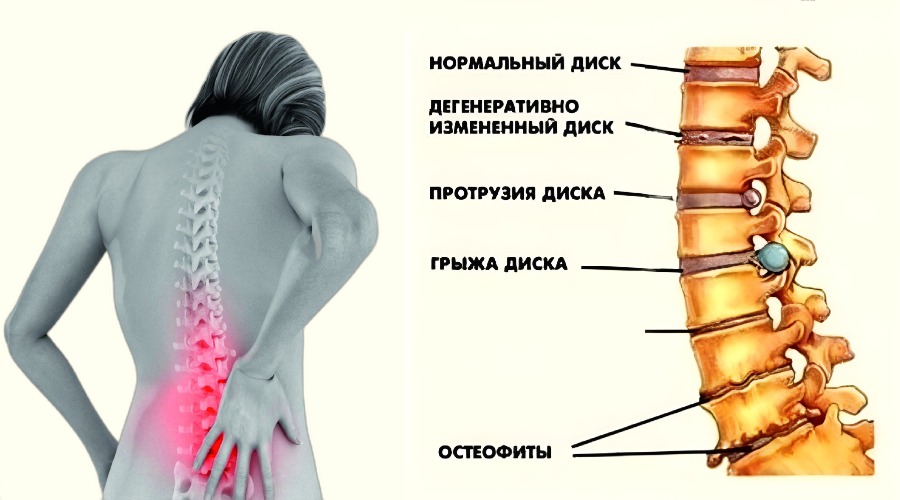 Заболевания позвоночника