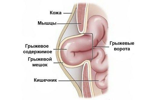 Из чего состоит грыжа?