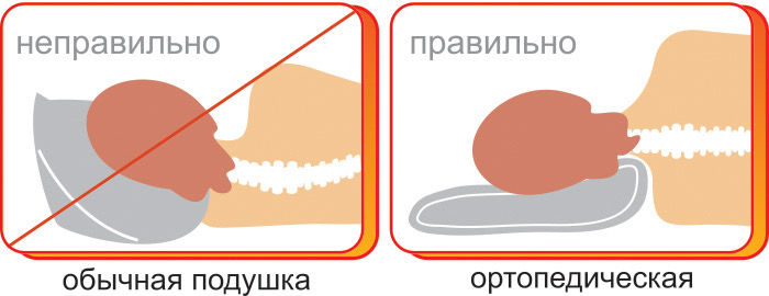 Положение головы на обычной и ортопедической подушке